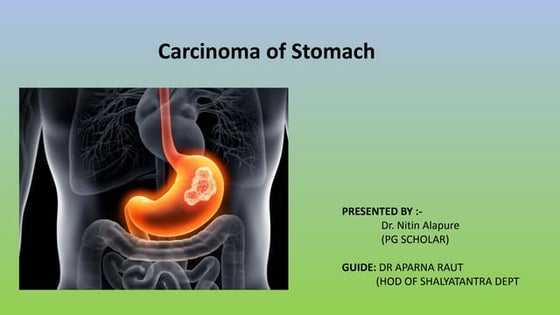 Stomach CA by Dr. Nitin Alapure
