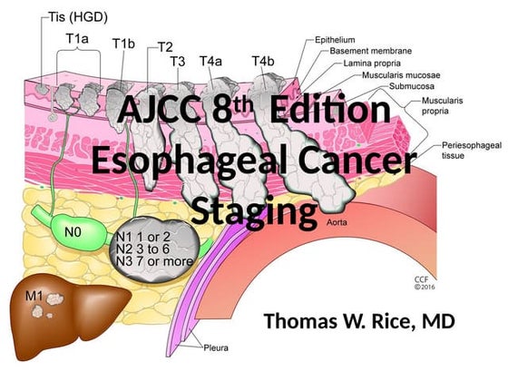 esophagus-8th-ed.pptx RAD ONCO ; ESOPHAGUS