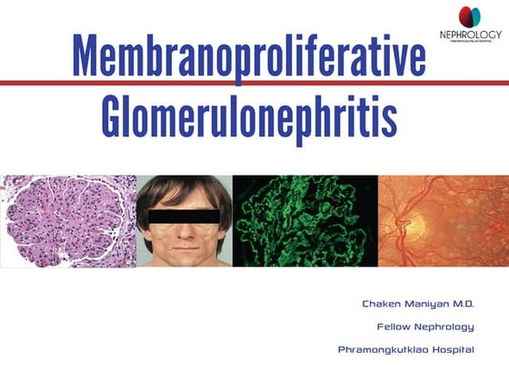Membranoproliferative Glomerulonephritis  MPGN chaken 