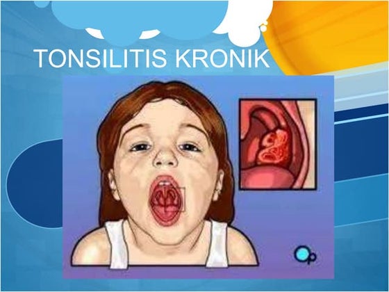 Tonsilitis kronis