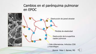 Destrucción de pared alveolar
Pérdida de elasticidad
Destrucción de la superficie
capilar pulmonar
↑ Céls inflamatorias, linfocitos CD8
y macrófagos
Source: Peter J. Barnes, MD
Cambios en el parénquima pulmonar
en EPOC
 