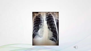 EPOC Diagnostico y Clasificación v2