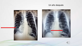 Un año después
 