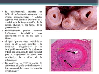 • La histopatología muestra un
infiltrado inflamatorio compuesto por
células mononucleares y células
gigantes que generan granulomas y
condicionan la fragmentación de la
media, elástica y, por tanto, de la
pared vascular.
• Posteriormente pueden aparecer
fenómenos trombóticos con
obliteración de la luz del vaso y
fibrosi.
• Al igual que en otras vasculitis —
como la de células gigantes—, la
resonancia magnética112 y la
tomografía con emisión de positrones
(PET) han demostrado gran utilidad
para el diagnóstico, así como para
monitorizar la actividad de la
enfermedad.
• En concreto, la PET es capaz de
demostrar el grado de inflamación y
la extensión de la misma con una alta
sensibilidad113.
 