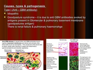 Causes, types & pathogenesisCauses, types & pathogenesis
Type I (Anti – GBM antibody)Type I (Anti – GBM antibody)
 IdiopathicIdiopathic
 Goodpasture syndrome – it is due to anti GBM antibodies evoked byGoodpasture syndrome – it is due to anti GBM antibodies evoked by
antigens present in Glomerular & pulmonary basement membraneantigens present in Glomerular & pulmonary basement membrane
(goodpastures antigen)(goodpastures antigen)
There is renal failure & pulmonary haemorrahgeThere is renal failure & pulmonary haemorrahge
4848
 