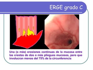 ERGE grado C Una (o más) erosiones continuas de la mucosa entre las crestas de dos o más pliegues mucosos, pero que involucran menos del 75% de la circunferencia   