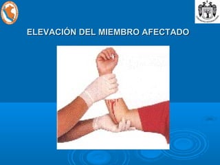 ELEVACIÓN DEL MIEMBRO AFECTADOELEVACIÓN DEL MIEMBRO AFECTADO
 
