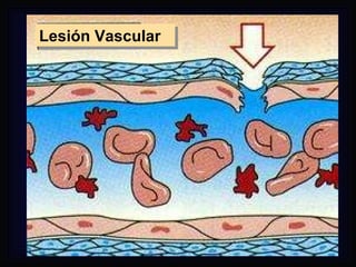Lesión Vascular 