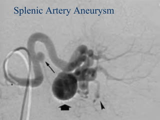 Splenic Artery Aneurysm
 