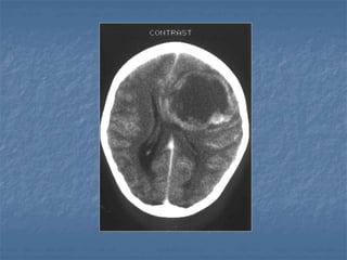 12 B. CT Brain.ppt