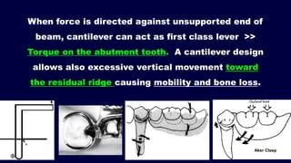 When force is directed against unsupported end of
beam, cantilever can act as first class lever >>
Torque on the abutment tooth. A cantilever design
allows also excessive vertical movement toward
the residual ridge causing mobility and bone loss.
Aker Clasp
 