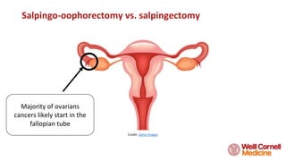 Salpingo-oophorectomy vs. salpingectomy
Credit: Getty Images
Majority of ovarians
cancers likely start in the
fallopian tube
 