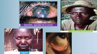 oncocercosis 