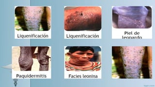 oncocercosis 