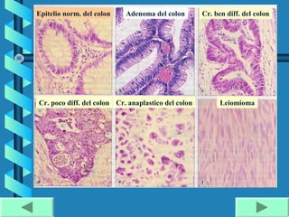 Epitelio norm. del colon    Adenoma del colon        Cr. ben diff. del colon




Cr. poco diff. del colon Cr. anaplastico del colon         Leiomioma
 