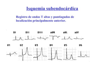 Isquemia subendocárdica Registro de ondas T altas y puntiagudas de localización principalmente anterior. 