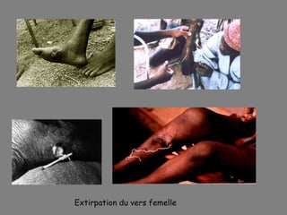 Extirpation du vers femelle
 
