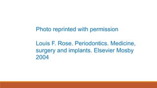 Photo reprinted with permission
Louis F. Rose. Periodontics. Medicine,
surgery and implants. Elsevier Mosby
2004
 