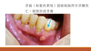 醫藥人 楊幽幽   注意有否刷蝕牙齒 170