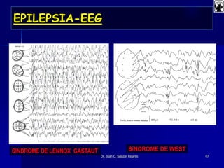 EPILEPSIA-EEG
Dr. Juan C. Salazar Pajares
SINDROME DE LENNOX GASTAUT SINDROME DE WEST
47
 