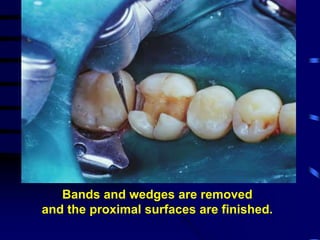 Bands and wedges are removed
and the proximal surfaces are finished.
 