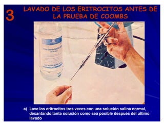 3
LAVADO DE LOS ERITROCITOS ANTES DE
LA PRUEBA DE COOMBS
a) Lave los eritrocitos tres veces con una solución salina normal,
decantando tanta solución como sea posible después del último
lavado
 