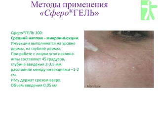 Методы применения
«Сферо®ГЕЛЬ»
Сферо®ГЕЛЬ 100:
Средний наппаж - микроинъекции.
Инъекции выполняются на уровне
дермы, на глубине дермы.
При работе с лицом угол наклона
иглы составляет 45 градусов,
глубина введения 2-3.5 мм,
расстояние между инъекциями –1-2
см.
Иглу держат срезом вверх.
Объем введения 0,05 мл
 