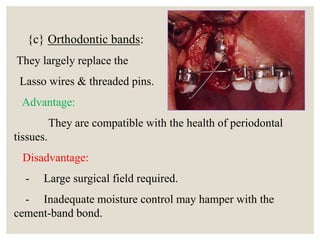 {c} Orthodontic bands:
They largely replace the
Lasso wires & threaded pins.
Advantage:
They are compatible with the health of periodontal
tissues.
Disadvantage:
- Large surgical field required.
- Inadequate moisture control may hamper with the
cement-band bond.
 