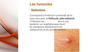 Les furoncles
Définition
Correspond à l’infection profonde de la
base d’un poil, le follicule pilo-sébacé;
L’infection est due à une
bactérie: un staphylocoque doré
Ils atteignent électivement les
adolescents et les jeunes adultes.
 
