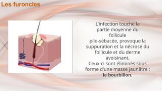 L'infection touche la
partie moyenne du
follicule
pilo-sébacée, provoque la
suppuration et la nécrose du
follicule et du derme
avoisinant.
Ceux-ci sont éliminés sous
forme d'une masse jaunâtre :
le bourbillon.
Les furoncles
 