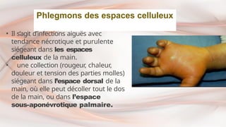 • Il s’agit d’infections aiguës avec
tendance nécrotique et purulente
siégeant dans les espaces
celluleux de la main.
• une collection (rougeur, chaleur,
douleur et tension des parties molles)
siégeant dans l’espace dorsal de la
main, où elle peut décoller tout le dos
de la main, ou dans l’espace
sous-aponévrotique palmaire.
Phlegmons des espaces celluleux
 