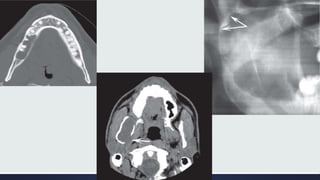 Radiographic Interpretation of Cyst and Cyst-like Lesions of the Jaws