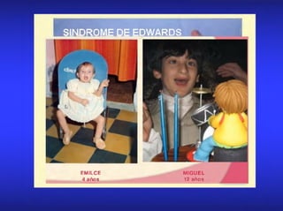 SINDROME DE EDWARDS
EMILCE
4 años
MIGUEL
12 años
 