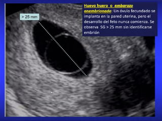 Huevo huero o embarazo
anembñonado: Un óvulo fecundado se
implanta en la pared uterina, pero el
desarrollo del feto nunca comienza. Se
observa SG > 25 mm sin identificarse
embrión
W r l
 