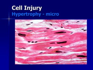 Cell Injury
Hypertrophy - micro
 