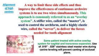 A way to limit these side effects and thus
improve the effectiveness of continuous archwire
systems is to use two wires simultaneously. This
approach is commonly referred to as an “overlay
system”. A stiffer wire, called the “master”, is
used to control the archform, and a highly elastic
wire, called the “server”, to deliver the forces
needed for tooth alignment
Same patient treated with active overlay
system for sagittal and transverse expansion. Use
of .019"  .026" stainless steel master wire during
canine leveling will prevent canting of occlusal
plane.
Alignment
of high
canines
 