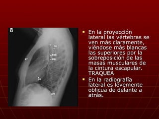 En la proyección lateral las vértebras se ven más claramente, viéndose más blancas las superiores por la sobreposición de las masas musculares de la cintura escapular. TRAQUEA En la radiografía lateral es levemente oblicua de delante a atrás. 