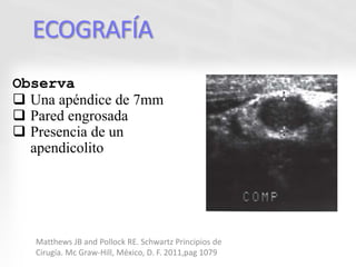 ECOGRAFÍA
Observa
 Una apéndice de 7mm
 Pared engrosada
 Presencia de un
apendicolito
Matthews JB and Pollock RE. Schwartz Principios de
Cirugía. Mc Graw-Hill, México, D. F. 2011,pag 1079
 