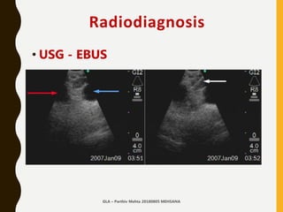 Radiodiagnosis
• USG - EBUS
–Must
–Defines structure
–Helps identify site
–Precision
GLA – Parthiv Mehta 20180805 MEHSANA
 