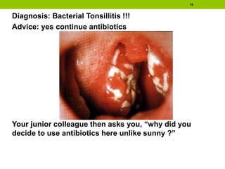 Diagnosis: Bacterial Tonsillitis !!!
Advice: yes continue antibiotics
Your junior colleague then asks you, “why did you
decide to use antibiotics here unlike sunny ?”
10
 