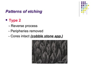 Patterns of etching
 Type 2
- Reverse process
- Peripheries removed
- Cores intact (cobble stone app.)
www.indiandentalacademy.com
 