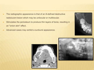  The radiographic appearance is that of an ill-defined destructive
radiolucent lesion which may be unilocular or multilocular.
 Stimulates the periosteum to produce thin layers of bone, resulting in
an "onion skin" effect.
 Advanced cases may exhibit a sunburst appearance.
 