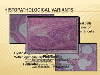 HISTOPATHOLOGICAL VARIANTS
Islands –
Central polyhedral cells
Surrounded by layer of
cuboidal / Columnar cells
Cystic degenerations –
Within epithelial islands
Follicular
Plexiform
Tumor epithelium in a network
Cyst formation – within stroma
Acanthomatous
0 Extensive squamous metaplasia
0 Keratin formation
Granular
0 Granular transformation of central stellate cells –
round/columnar/cuboidal
0 Acidophillic granules – lysosomal aggregates
Basal
 