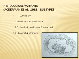 HISTOLOGICAL VARIANTS
(ACKERMAN ET AL, 1988 - SUBTYPES)
1. - Luminal UA
1.2 - Luminal & Intraluminal UA
1.2.3 - Luminal, Intraluminal & intramural
1.3 - Luminal & Intramural
 