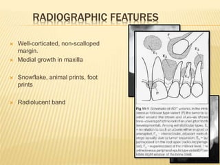 RADIOGRAPHIC FEATURES
 Well-corticated, non-scalloped
margin.
 Medial growth in maxilla
 Snowflake, animal prints, foot
prints
 Radiolucent band
 