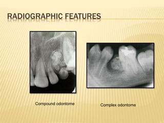 RADIOGRAPHIC FEATURES
Compound odontome Complex odontome
 