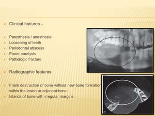  Clinical features –
 Paresthesia / anesthesia
 Loosening of teeth
 Periodontal abscess
 Facial paralysis
 Pathologic fracture
 Radiographic features
 Frank destruction of bone without new bone formation
within the lesion or adjacent bone.
 Islands of bone with irregular margins
 