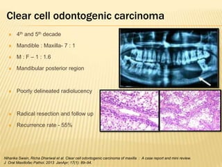 Clear cell odontogenic carcinoma
 4th and 5th decade
 Mandible : Maxilla- 7 : 1
 M : F – 1 : 1.6
 Mandibular posterior region
 Poorly delineated radiolucency
 Radical resection and follow up
 Recurrence rate - 55%
Niharika Swain, Richa Dhariwal et al. Clear cell odontogenic carcinoma of maxilla : A case report and mini review.
J Oral Maxillofac Pathol. 2013 JanApr; 17(1): 89–94.
 