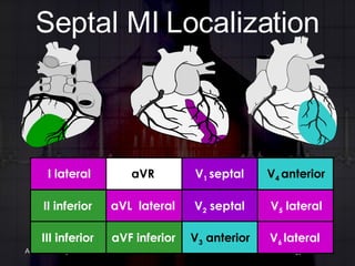 Septal MI Localization aVF inferior III inferior V 3  anterior V 6  lateral aVL  lateral II inferior V 2  septal V 5  lateral aVR I lateral V 1  septal V 4  anterior 