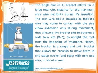• The single slot (X-1) bracket allows for a
large inter-slot distance for the maximum
arch wire flexibility during it's insertion.
The arch-wire slot is elevated so that the
wire may come in contact with the side
elbow extension only during movement,
thus allowing the bracket slot to become a
wide twin slot (X-2), to upright the root
from the beginning of treatment. Hence,
the bracket is a single and twin bracket
that allows the clinician to move teeth in
one stage (crown and root) with only one
wire, in about a year.
www.indiandentalacademy.co
m
 
